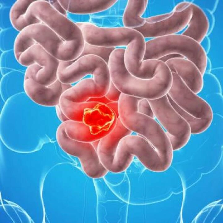 Bowel Cancer 01